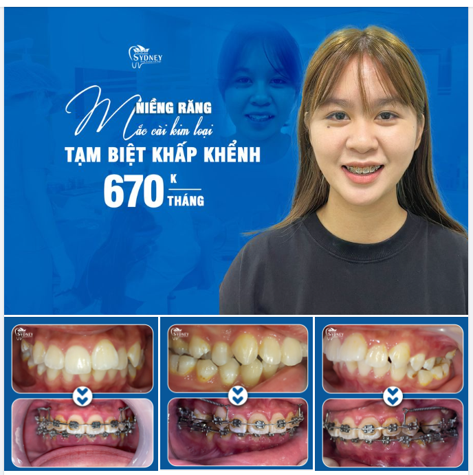 NIỀNG RĂNG – BÍ QUYẾT TẠM BIỆT HÀM RĂNG KHẤP KHỂNH