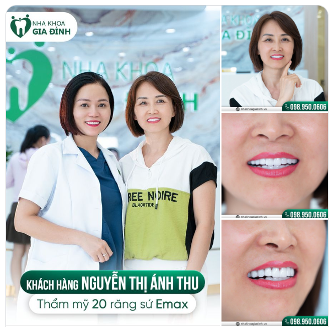 TỪNG BỌC RĂNG SỨ KIM LOẠI, ĐẾN THỜI ĐIỂM NÀY CHỊ KHÁCH Ở SƠN LA PHẢI THÁO RA LÀM LẠI