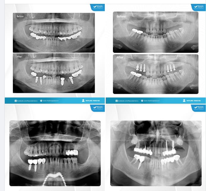 Đã cấy ghép implant thì phải chọn nha khoa uy tín, bác sĩ giỏi, trang thiết bị hiện đại và trụ implant chất lượng.