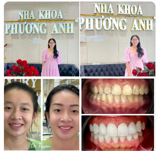 Hình ảnh BN trước & sau khi được bác sĩ làm thẩm mỹ 16 răng sứ cao cấp.