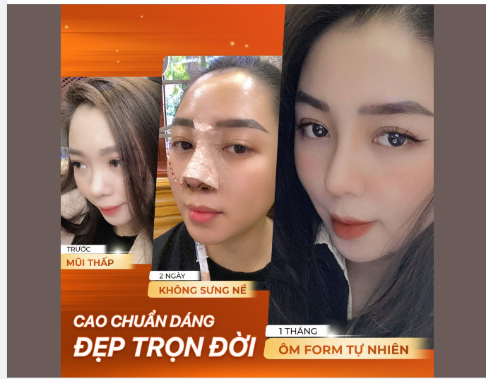 MŨI CAO CHUẨN DÁNG - CHUẨN TỶ LỆ VÀNG