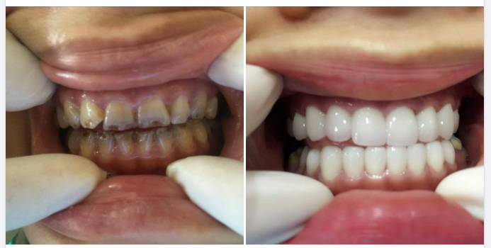 5 tiêu chuẩn hàm răng đẹp tự nhiên mà bạn nên biết