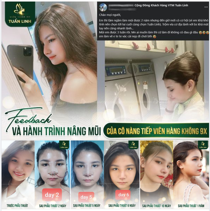 Cô nàng tiếp viên hàng không 9x xinh đẹp và thành công sau nâng mũi