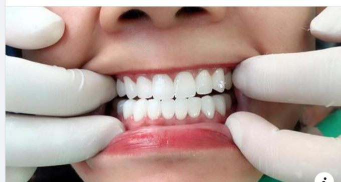 Tương thích sinh học Răng sứ ht-smile