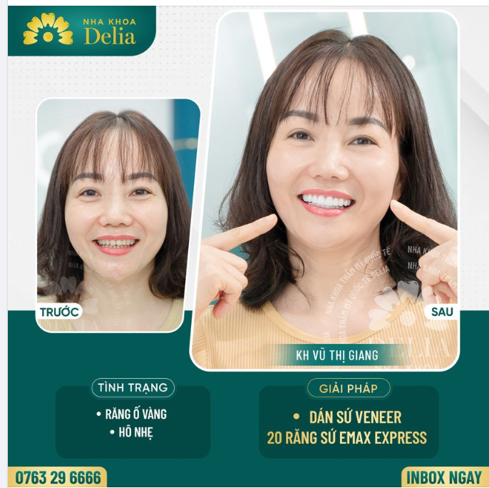 Thẩm mỹ 20 răng sứ Emax ExPress cao cấp » Kiến tạo nụ cười khỏe đẹp rạng rỡ