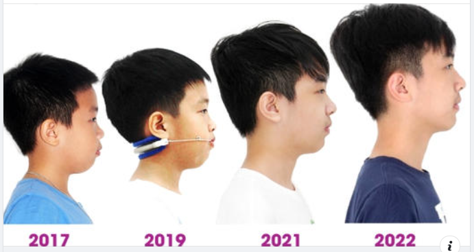 ĐƯA CON ĐI NIỀNG RĂNG TỪ 9 TUỔI VÌ KHÔNG MUỐN CON HÔ GIỐNG BỐ