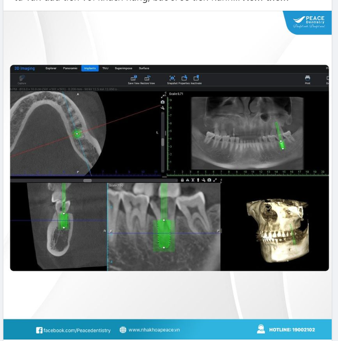 MÔ PHỎNG  VỊ TRÍ,  KÍCH THƯỚC VÀ  TƯƠNG QUAN CỦA IMPLANT TRÊN PHẦN MỀM