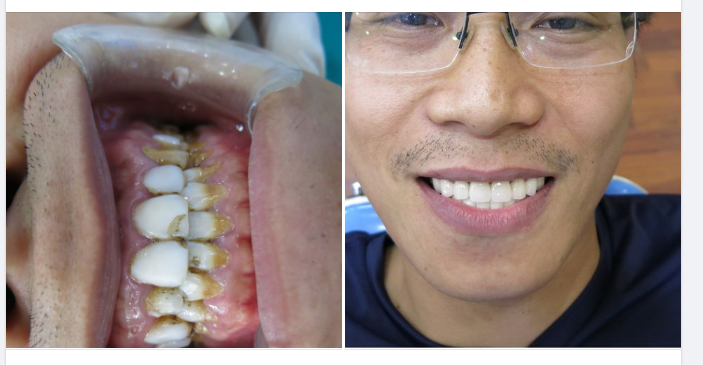 Cách Chăm Sóc Để Răng Sứ Tồn Tại Lâu Dài Hơn