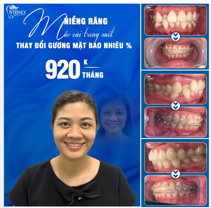 NIỀNG RĂNG THAY ĐỔI KHUÔN MẶT BAO NHIÊU %?