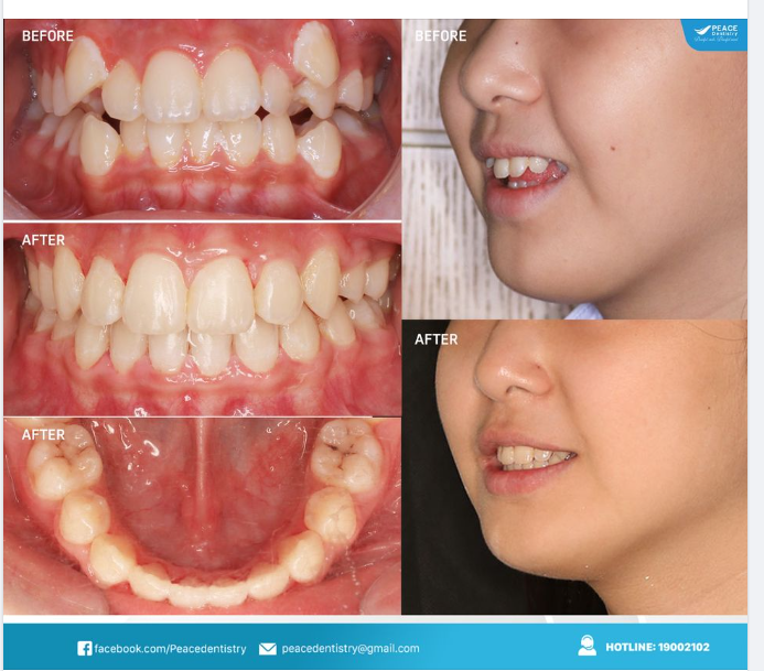 MỘT NỤ CƯỜI KHOẺ MẠNH VÀ THẨM MỸ CÓ THỂ NÂNG CAO CHẤT LƯỢNG CUỘC SỐNG!