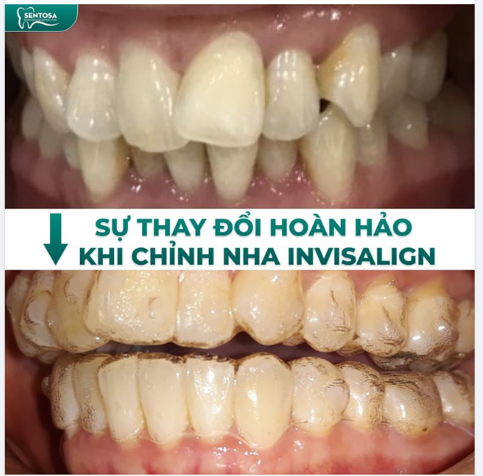 SỰ THAY ĐỔI HOÀN HẢO KHI CHỈNH NHA INVISALIGN