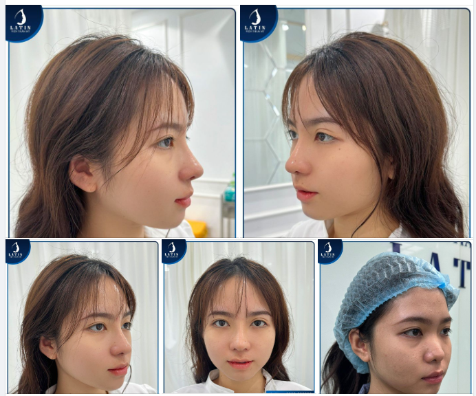 Mũi cấu trúc surgiform 10 ngày tuổi đẹp mê ly cho em gái đi từ Đồng Nai lên Sài Gòn làm đẹp. Ngày tái khám và cắt chỉ, em đã có dáng mũi cao thanh thoát như mình luôn hằng mong ước.