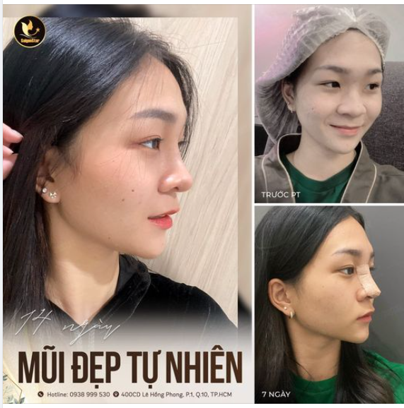 Dáng mũi 14 ngày – Đẹp như chưa hề “can thiệp”