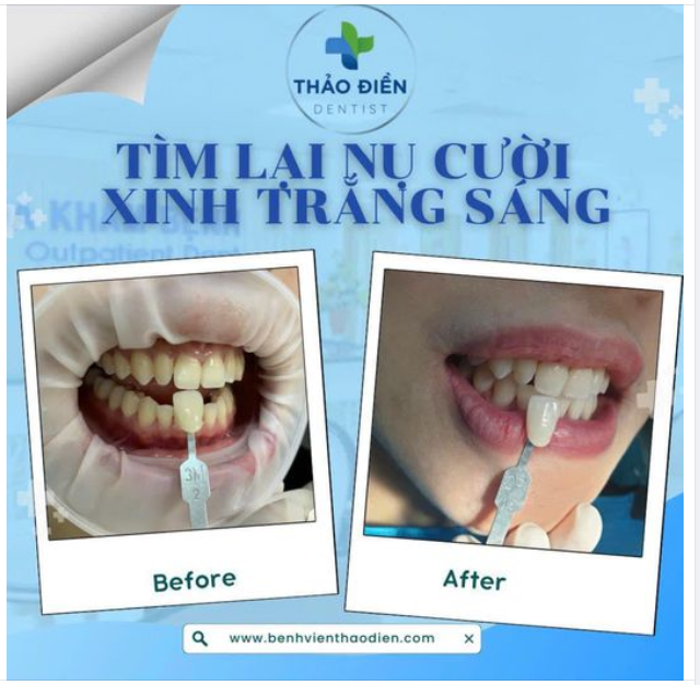 TẨY TRẮNG RĂNG- TÌM LẠI NỤ CƯỜI XINH TRẮNG SÁNG