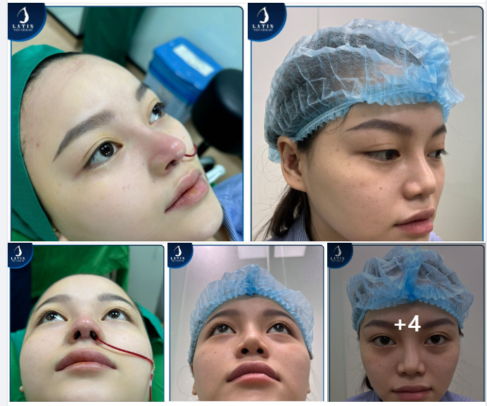 Sửa lại mũi lệch, lộ sóng cho em gái trẻ tuổi