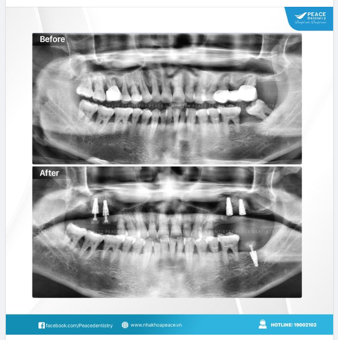 NGAY KHI RĂNG THẬT KHÔNG CÒN HY VỌNG THÌ KẾ HOẠCH TRỒNG RĂNG IMPLANT NÊN ĐƯỢC ĐẶT RA