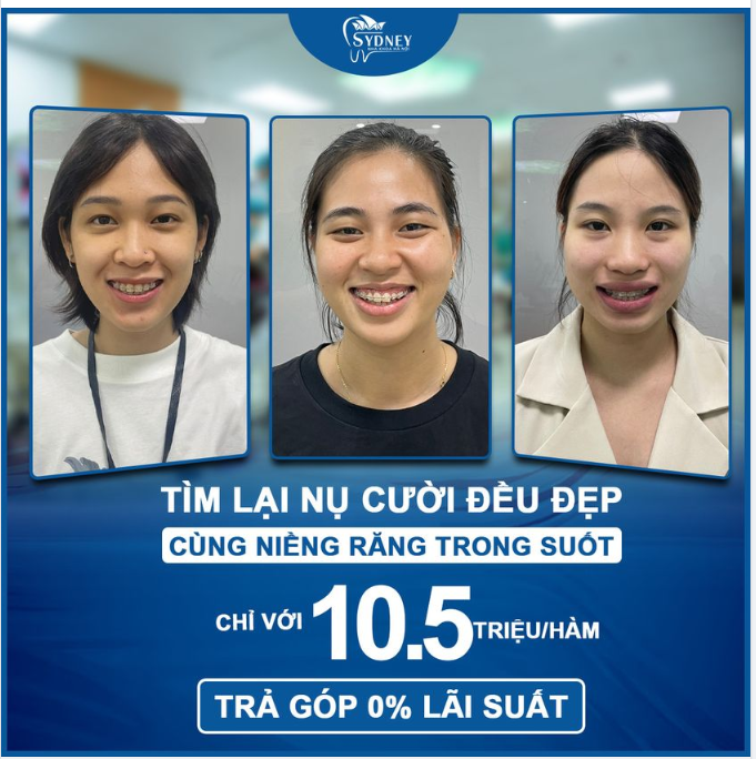 NIỀNG RĂNG MẮC CÀI PHA LÊ – NIỀNG RĂNG THẨM MỸ CHO HIỆU QUẢ VƯỢT TRỘI
