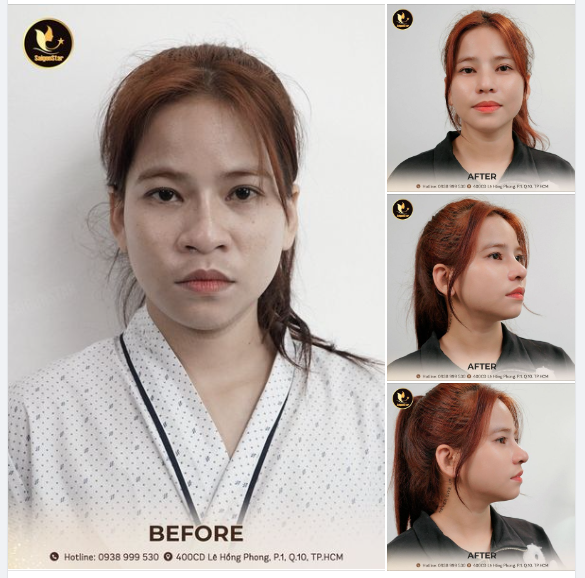 13 NGÀY VỚI DÁNG MŨI ĐỘC QUYỀN DR. HOẠT