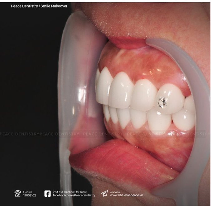 LÀM RĂNG SỨ THẨM MỸ: NHỮNG THÔNG TIN KHÔNG CHÍNH XÁC!