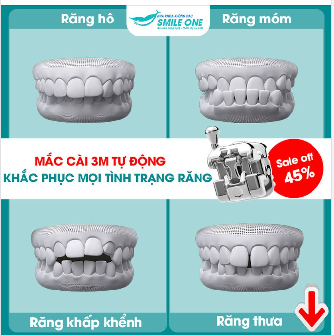 RĂNG HÔ, RĂNG THƯA, RĂNG MÓM, RĂNG KHẤP KHỂNH làm bạn tự ti, ngại giao tiếp,...