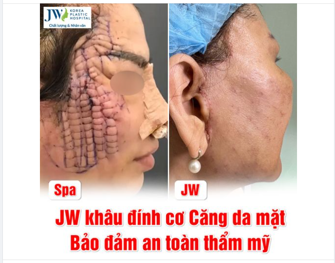 SỰ THẬT VỀ CĂNG DA MẶT KHÂU ĐÍNH CƠ TRONG PHẪU THUẬT THẨM MỸ