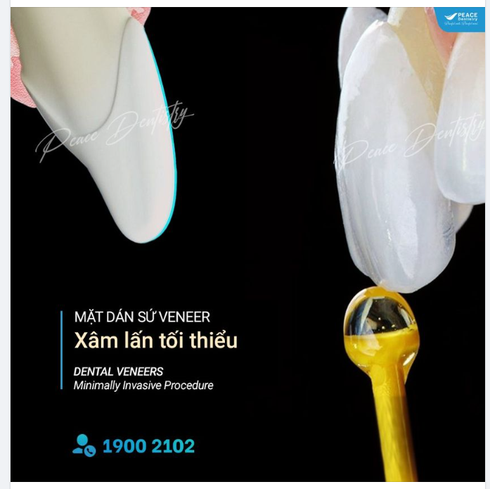 Nâng tầm nụ cười với  mặt dán sứ veneer xâm lấn tối thiểu /English below/