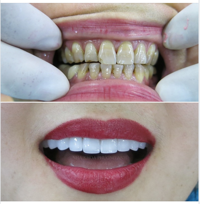 Những điểm đặc biệt của răng sứ thẩm mỹ