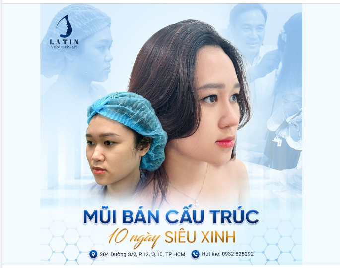 Kết quả tuyệt vời nâng mũi bán cấu trúc sau 10 ngày