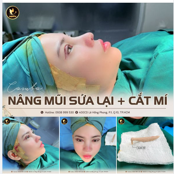 COMBO NÂNG MŨI SỬA LẠI + CẮT MÍ MẮT