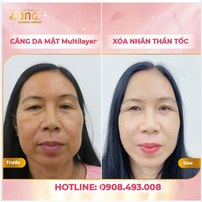 ​​​​​​​VÌ SAO NHẤT ĐỊNH PHẢI TRẺ HÓA DA BẰNG PHƯƠNG PHÁP NÀY???