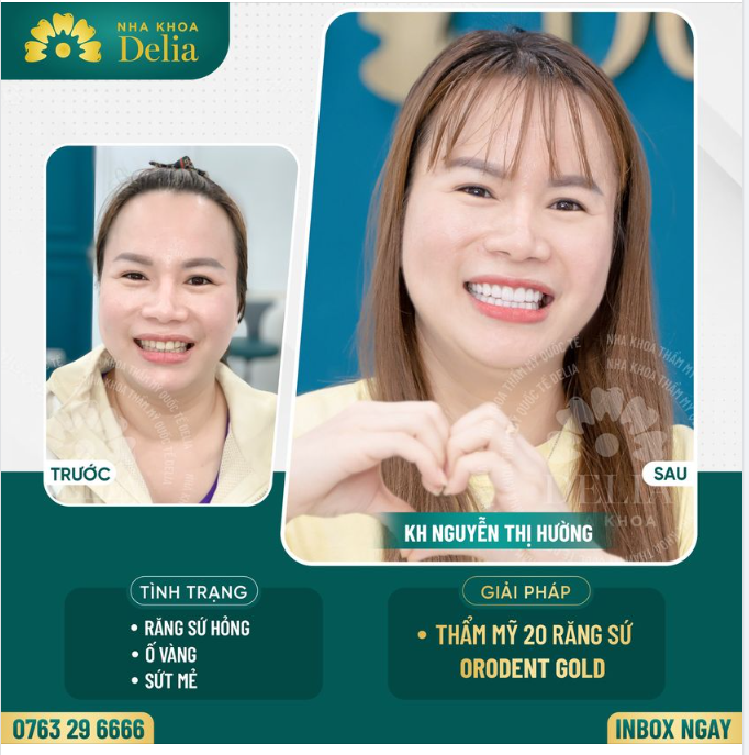 Thẩm mỹ răng sứ - Kiến tạo nụ cười tự tin rạng rỡ