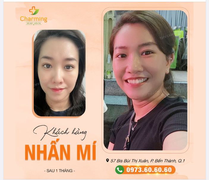 Nhấn mí sao quá tuyệt vời. Chỉ sau một tháng đã ngời nét duyên. Hậu phẫu cũng chẳng cần siêng. Vài ngày là đủ, không lo chăm nhiều.