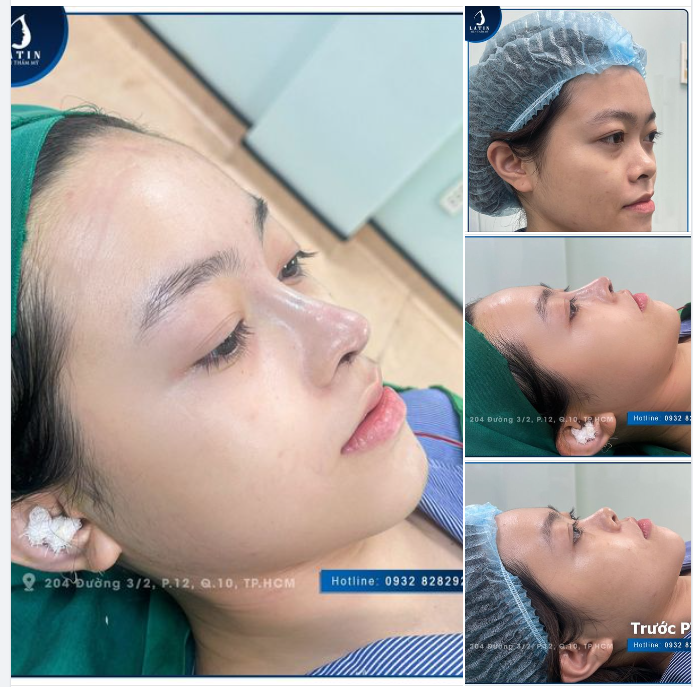 Cô gái ấy thay đổi gì ngay sau khi nâng mũi