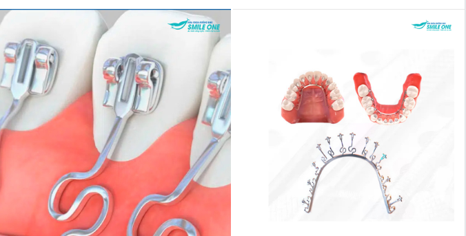 “HỆ THỐNG NẮN CHỈNH CHÂN RĂNG ĐỘC LẬP - CÔNG NGHỆ ĐỘT PHÁ TRONG CHỈNH NHA”.