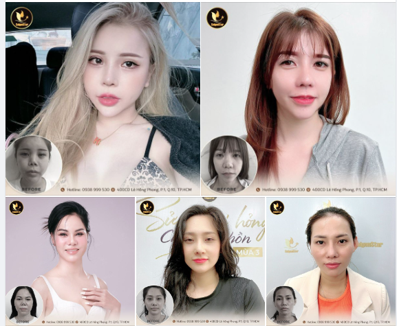 THỜI ĐIỂM NÀO NÊN ĐẶT LẠI SỐNG MŨI MỚI