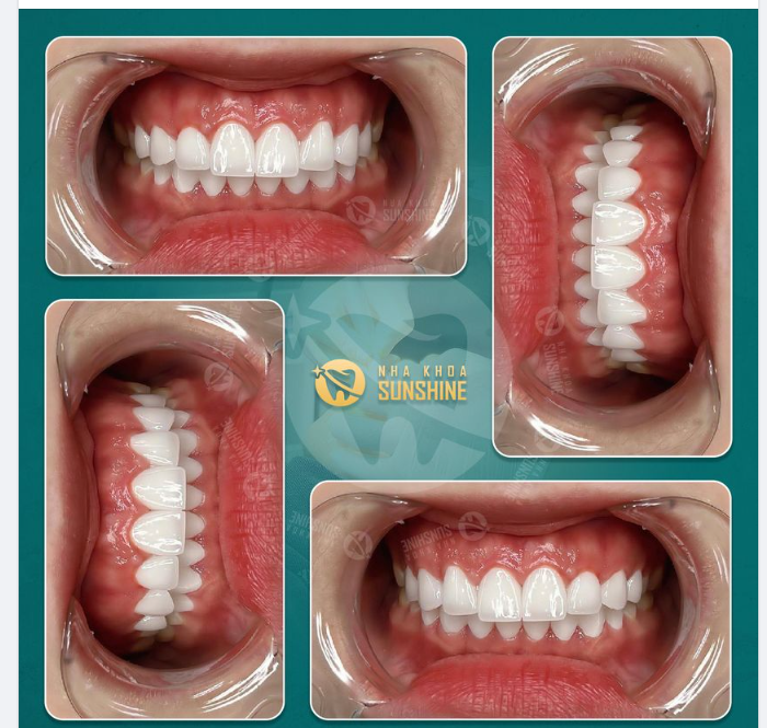 Với những ưu điểm vượt trội đó, đa số khách hàng đã quyết định lựa chọn những dòng răng toàn sứ để khắc phục khuyết điểm răng của mình.
