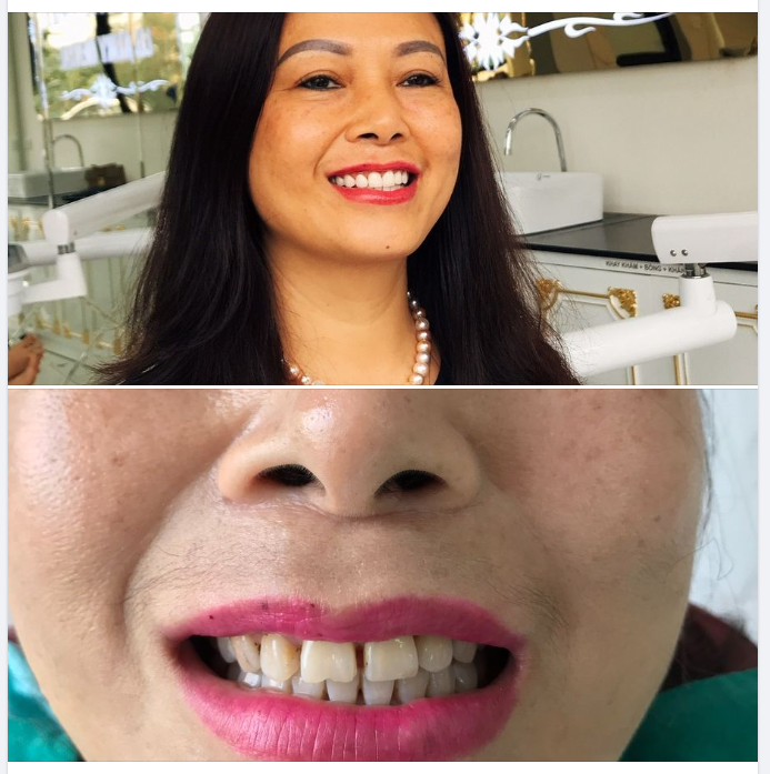 Những khiếm khuyết nụ cười mà bạn nên cải thiện