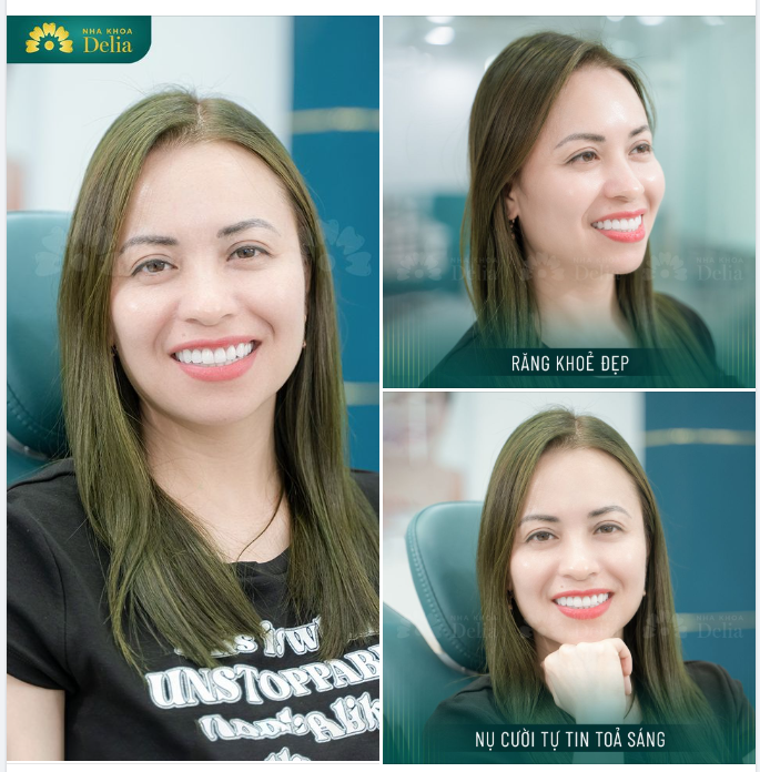 Chị Minh Hà chia sẻ sau khi sở hữu nụ cười răng sứ trắng sáng, khỏe đẹp tại Delia