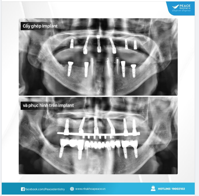 TRỒNG RĂNG IMPLANT CÓ THỂ ĂN NHAI VỚI RĂNG MỚI CHỈ SAU VÀI NGÀY?