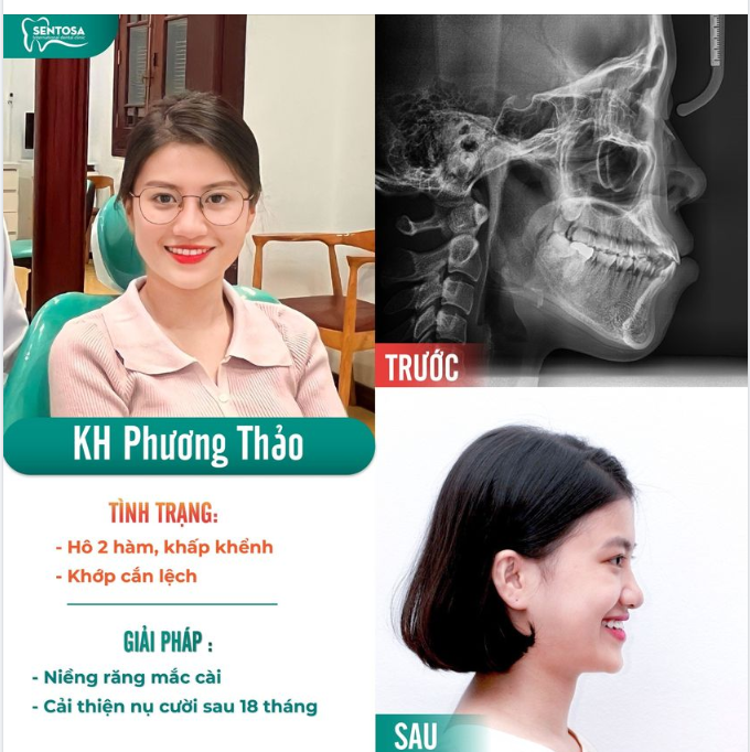KHÔNG HỀ ĐÁNG SỢ - NIỀNG RĂNG LÀ "THIÊN THẦN" MANG ĐẾN SỰ THÀNH CÔNG