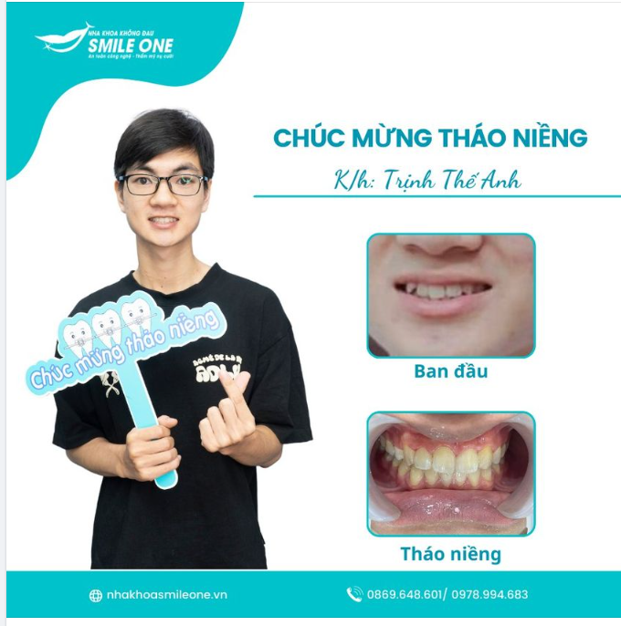 Chúc mừng bạn Thế Anh đã về đích xuất sắc trên hành trình niềng răng của mình.