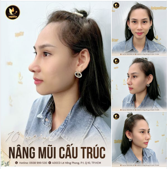 10 NGÀY NÂNG MŨI CẤU TRÚC