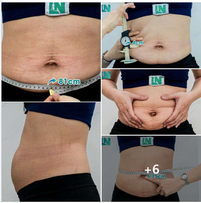 CHỊ KH 9X, TÌM LẠI DÁNG VÓC SAU SINH, TIN TƯỞNG THỰC HIỆN VỚI GIẢI PHÁP GIẢM MỠ AN TOÀN. 