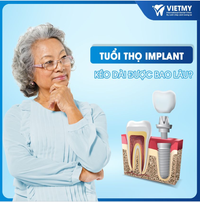 RĂNG IMPLANT TUỔI THỌ ĐƯỢC BAO LÂU?