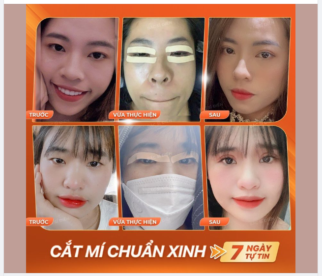 CẮT MÍ CHUẨN XINH - 7 NGÀY TỰ TIN