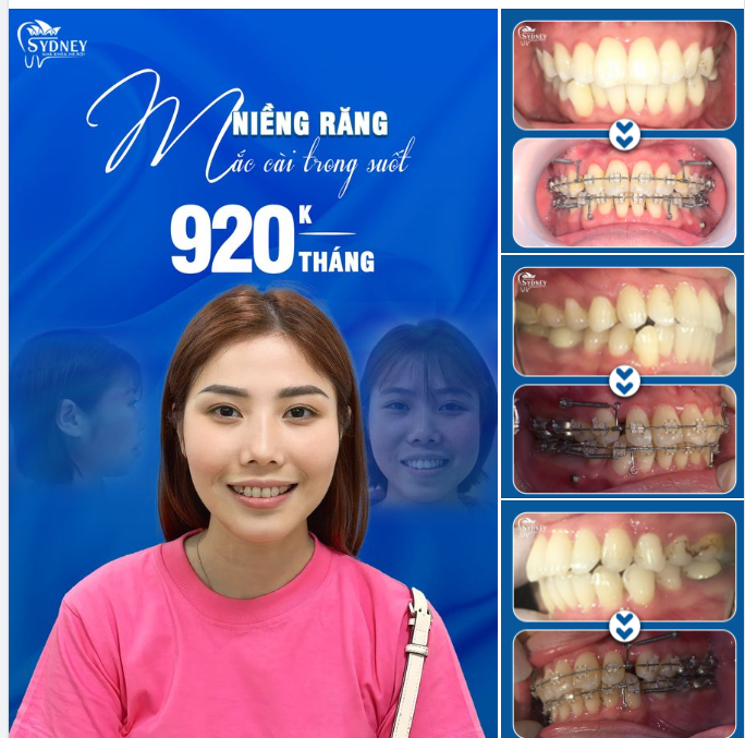 NIỀNG RĂNG SỞ HỮU NỤ CƯỜI XINH NGAY HÔM NAY
