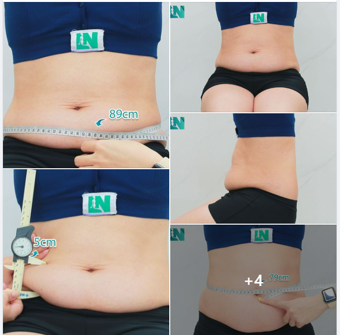 HÚT MỠ TẠO DÁNG THẨM MỸ CHO CHỊ KH 7X, BÀ MẸ 2 CON – MONG MUỐN TÌM LẠI DÁNG VÓC GỌN THON SAU SINH.