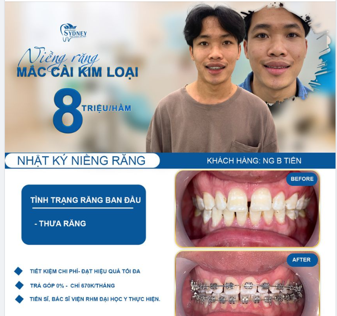 NIỀNG RĂNG KHẮC PHỤC HOÀN TOÀN THƯA HỞ