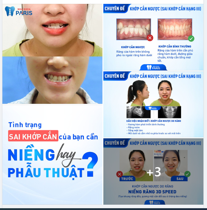 Sai Khớp Cắn, Hàm Móm có ảnh hưởng thế nào? Vì sao cần điều trị đúng càng sớm càng tốt?