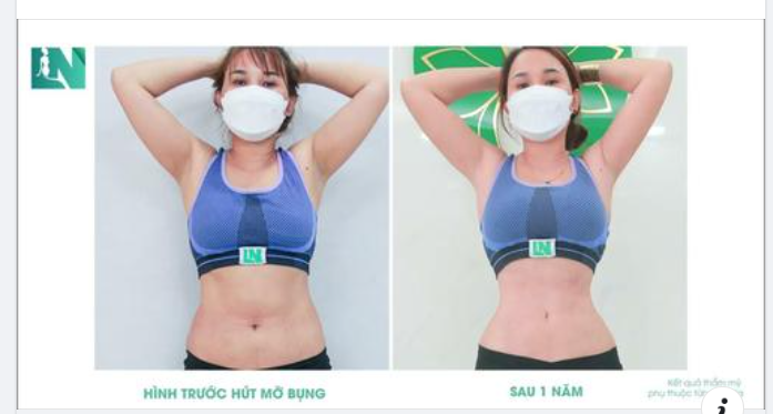 Bạn có thắc mắc? Đừng ngại hỏi Bác sĩ Lương Ngọc - Chuyên gia Hút mỡ tạo dáng thẩm mỹ